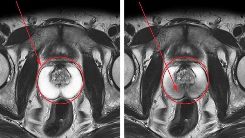 a healthy and inflamed prostate with chronic prostatitis